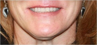 Lip augmentation - juvederm 435618