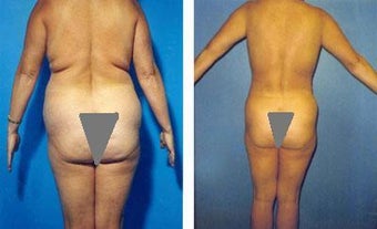 Liposuction of Back Rolls before 289516