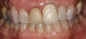 porcelain crowns and porcelain veneers before 312959