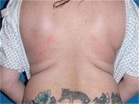 Liposuction before 631026