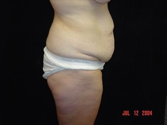Body Lift with Liposuction of Abdomen, Waist, and Flanks before 203461