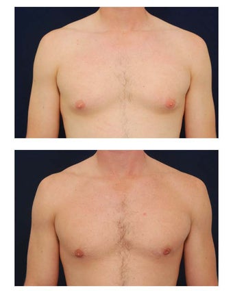 Gynecomastia before 349235