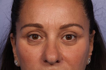 Eyelid Surgery after 306424
