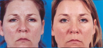 Botox before 574299