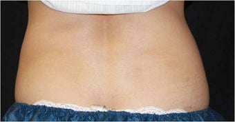CoolSculpting before 421631