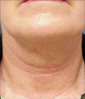 Thermage after 135923