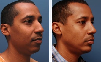 Rhinoplasty after 314275