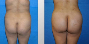 Buttock augmentation by fat transfer before 163653