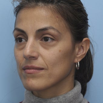 Cheek Dermafiller, Under Eye Dermafiller, Face Dermafiller 455491