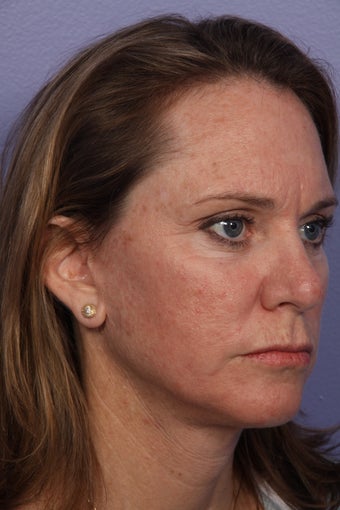 Neck Lift after 306407