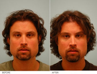 Botox Jaw Reduction before 229188