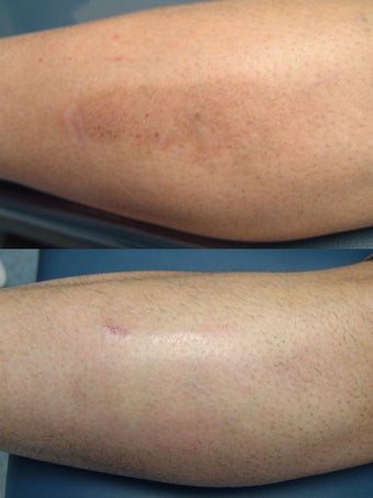 Intense Pulsed Light Laser before 228750