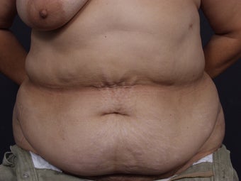 Post Tram Flap Abdomen - 46 Year Old Female for Breast Reconstruction before 643268