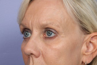 Eyelid Surgery after 306431