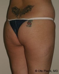 Buttock Augmentation 566723
