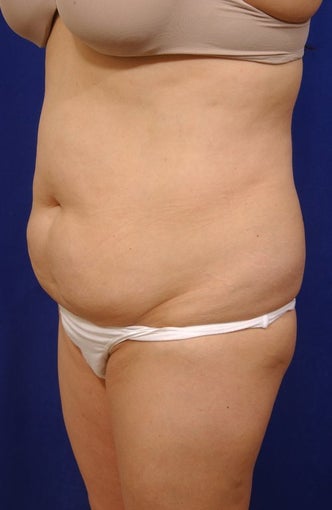 Abdominoplasty with liposculpture of abs, flanks, and waist before 82417