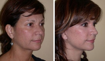 Necklift after 359779