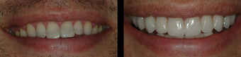 Smile Makeover with Veneers before 58930