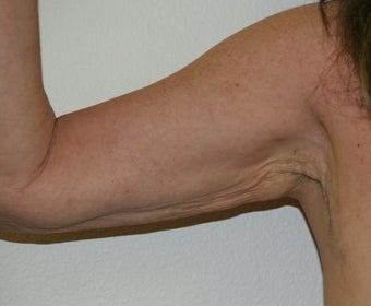Arm lift (brachioplasty) before 548317