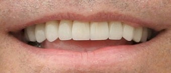 Porcelain Veneers Before and After (Smile Makeover) after 206793