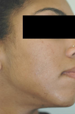 Laser Acne Treatment after 82952