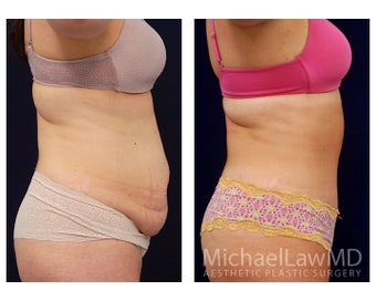 Abdominoplasty - Tummy Tuck 396126