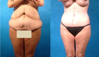Lower Body Lift with Liposuction and Fat Transfer before 101862