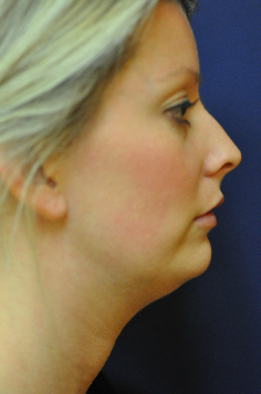 Jawline / Neck Lipo before 624697