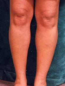 Women's Calf Augmentation 519045