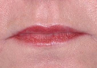 Radiesse and Restylane for Marionette Lines and Lips after 53016