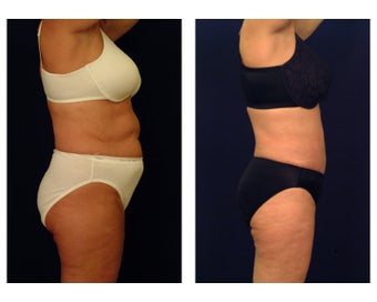 Liposuction 397053