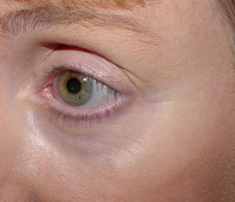 Affirm treatment of eye area wrinkles (crowsfeet) before 109815