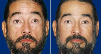 Sculptra before 496290