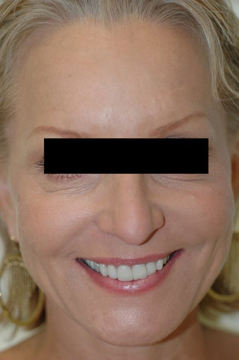 Dysport Injections Before and After Photos after 438319