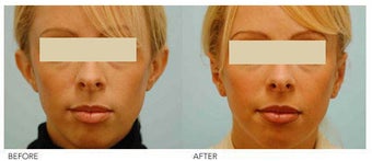 Otoplasty (Cosmetic Ear Pinning) before 136388
