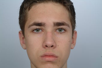 otoplasty after 358570