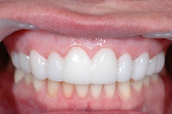 Combination Invisalign and Lumineers after 356802