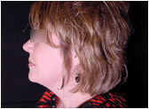 chin liposuction with platysmal plication (mini necklift) after 267584