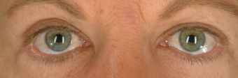 Botox for Wrinkle Treatment after 100338