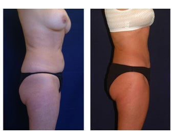 Tummy Tuck / Abdominoplasty before 55021