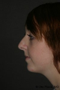 Chin Augmentation & Rhinoplasty before 565873