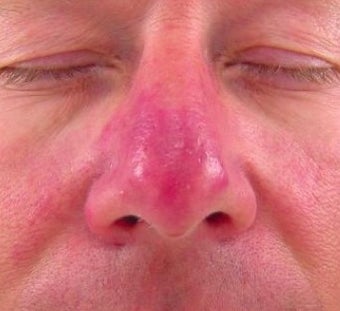 Vbeam for Rosacea Treatment before 374581