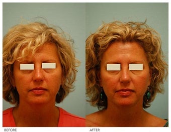 Botox before 138522