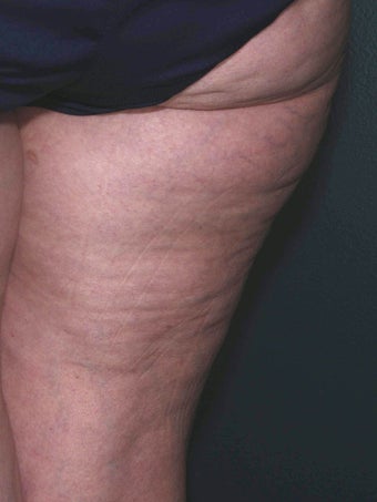 Cellulite treatment before 113275