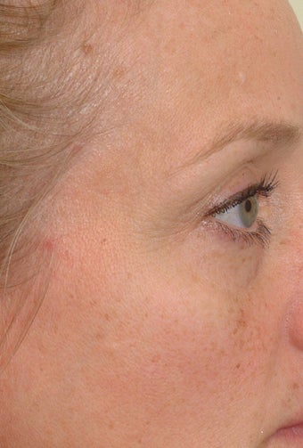 Pearl Laser Treatment before 102785