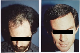 Hair Transplant before 369160