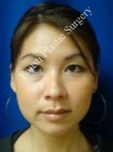 Ear Surgery (Otoplasty) after 579104