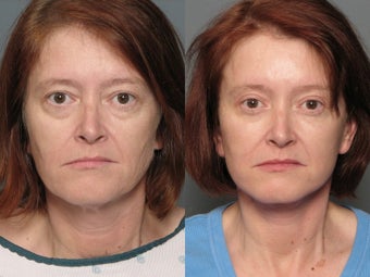 Brow Lift before 338739