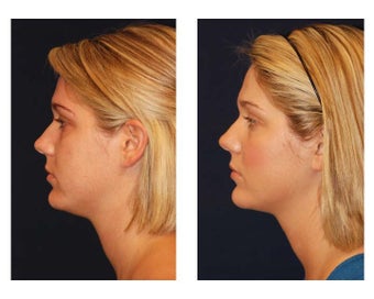 Chin Lipo after 347523