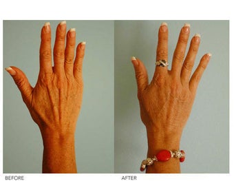 Hand Rejuvenation (with Fat Transfer) before 136430
